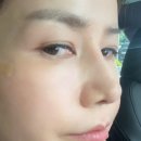 강남성형외과 팔자주름 없애는 팔자주름땡기미 쥬베룩볼륨 시술 솔직후기(통증 가격 효과)