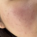 양산 | 부산 리투오 양산 피부과 후기 통증 멍 리쥬란비교