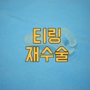 뉴맨남성의원 | 티링 교체 재수술 가능할까요?