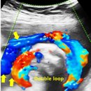 Double L | 정기 산전 검사를 받은 26세 여성-Divot sign in double nuchal cord(이중 목덜미 제대에서 나타나는...