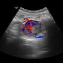 pancreas head mass 이미지
