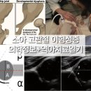 [소아] 아기 고관절 이형성증 : 역아 초음파 진단기준 정상 각도 치료법 기저귀요법 파브릭 보조기