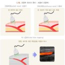동맥관 개존증[출생 직후에는 닫혀야 하는 대동맥과 폐동맥 사이의 관이 출생 후에도 닫히지 않고 열려 있는 질환] 이미지