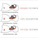 폐쇄성 수면무호흡증 (수면장애 증상과 치료) 이미지