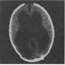 수두증 (Hydrocephalus) 이미지