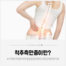 척추측만증(척추 옆굽음증) 원인과 증상, 한의원 치료방법 알아봐요!