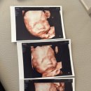 고은빛산부인과의원 | 송파고은빛산부인과 입체초음파 후기(26주5일차)