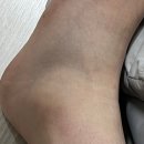 멍그라미 | 발목 염좌 4일차 정형외과 재방문 - 발목 냉각치료 엑스레이