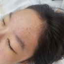 현대베스코아 | 학생여드름 블랙헤드 제거 하남 피부관리 율모공세척테라피