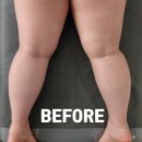 두산테라피 | 시오테라피 인비덤 하체부종빼기 마곡테라피 후기