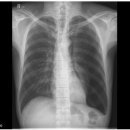 기흉(Pneumothorax): X-ray 이미지