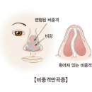 비중격 만곡[Nasal septal deviation]귀코목질환 이미지