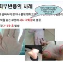 (손발 피부반응 관리) 21년 아산 기스트 건강강좌 발췌 이미지