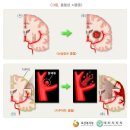 뇌졸중 진단비의 보험금 지급사유에 대해 보험수익자와 보험회사간에 합의하지 못할 경우에 반드시 대학병원에서 동시 자문을 해야합니까? 이미지