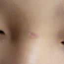 한현언성형외과 | [정보] 아이 얼굴 상처 봉합수술 시 고려해야 할 점