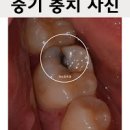 충치 치료 단계 증상과 통증에 대하여 이미지