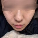 서울이내과의원 | [내돈내산] 압구정 루나의원 루비레이저 후기 | 일주일만에 주근깨 떨어진 후기 | 주근깨 제거 후기