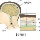 성인 뇌수막염 및 원인부터 방법까지 이미지