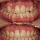 셉템버치과교정과치과의원 | [셉템버교정치과] "주걱턱인데 수술은 무서워요" 14세 소녀의 비수술 교정 성공기