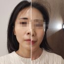 타이탄 | 친구 이브타이탄 후기 효과｜중안부 리프팅 고민하다 엠페이스랑 같이 알게 됐어요