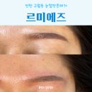 인천 구월동 눈썹 잔흔제거 르미에즈 2회차 후기 내돈내산