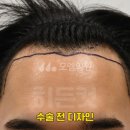 중앙헤어라인 이미지