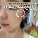 대구 흑자 제거 통증 및 전후 비교 후기 플라즈마 블라스트 지아뷰티