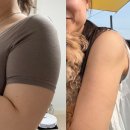 교대 팔 지방추출주사 2개월 후기 | 팔뚝 둘레 5cm 줄고 황금기 꺗