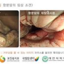 항문암 증상 원인 치질과 비교 치료는? 이미지