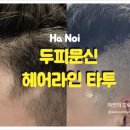 선헤어라인 이미지