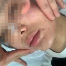 더 베스트 | 홍대 여드름 압출 미더베스트 여드름 재생관리 후기 추천