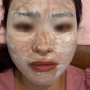 경북제일약국 | 부산 서면 주근깨 루비레이저 2탄 (1년후기 &amp; 재시술 후기/내돈내산)