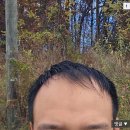 터키에서 모발이식 8천모 받은 디시인 후기 이미지