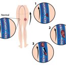 심부정맥 혈전증 원인과 치유 방법 이미지
