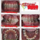 치아교정은 대체 어떻게하는건가?(+추가) 이미지
