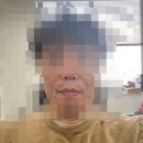 피부처침 및 노화로 인한 팔자주름 필러 시술 후기 1 -영등포 김종철 성형외과-