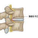 노년기에 흔한 요통 이미지