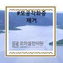 모공각화증제거 끝나고 드디어 빛본 후기 가즈아