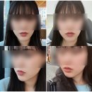 남부의원 | [리부팅의원] 인생 첫 입술필러 솔직후기! : 입술필러 맞은 후 관리