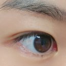 대연의원 | [241202] 부산 대연본안과 결막모반(눈에 생긴 점) 제거 후기