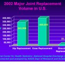 Shoulder Joint Replecement 이미지