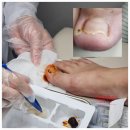 능곡동주민센터 | 발톱 무좀 치료, 유앤미재활의학과에서 한 번에 해결!(고양시 덕양구·화정·능곡 주민 추천 발관리센터)