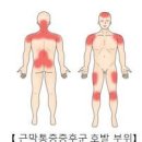 어깨,허리 통증 심할땐 근막 통증 증후군 의심 이미지