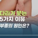 다리 부종 증상 원인 어느 병원으로 가야 할까? 이미지