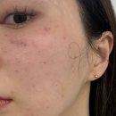 강남역 성형외과 후기 [도레 리프팅 인덱스 상담] 물광주사 연어주사 스킨부스터