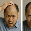 쏘팔메토 탈모약 영양제 효과 효능 동시복용