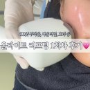 민영의원 | 대구 하프의원 올타이트리프팅 1회차 후기 울쎄라 써마지 비교
