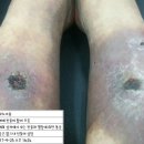 메디실 | 은나노 원액 사용후기-피부괴사 치료 진행중