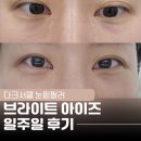 브라이트피부과의원 | 눈밑필러 추천, 도곡역피부과에서 브라이트아이즈로 다크서클+색소침착 개선한 후기