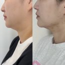 양덕로 | 마산 지방분해 잘하는 르메르뷰티에서 이중턱 관리 받은 후기